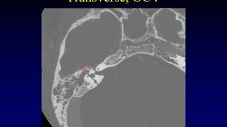 Temporal Bone Pathology 10 Trauma [upl. by Nipahc593]