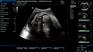 Ecografía Doppler Fetal [upl. by Anaujd]