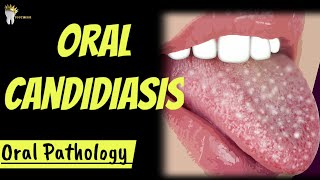 ORAL PATHOLOGY  ORAL CANDIDIASIS [upl. by Haseefan]