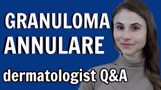 Granuloma annulare treatments and causes dermatologist Dr Dray [upl. by Oeram190]