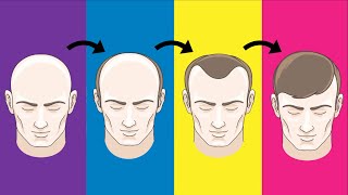 Top 5 Hair Loss Solutions That Actually Work [upl. by Euqininod]