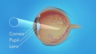 Detached Retina Pneumatic Retinopexy [upl. by Kaden]