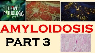 AMYLOIDOSIS PART 3 Morphology Diagnosis Special stains clinical features amp Prognosis [upl. by Aohk808]