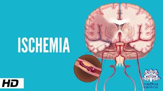 Ischemia Causes Signs and Symptoms Diagnosis and Treatment [upl. by Minerva]