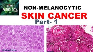 SKIN CANCER Non Melanocytic Part 1 Anatomy Etiopathogenesis amp Classification [upl. by Daren744]