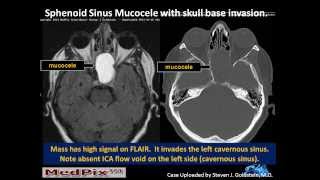 Aneurysmal Bone Cyst  Everything You Need To Know  Dr Nabil Ebraheim [upl. by Seema]