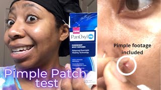 Review of the Panoxyl PM Overnight Spot Patches  Pimple popping included Ri’s Remedies [upl. by Udele]