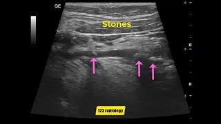 Submandibular duct stones [upl. by Ateekram528]