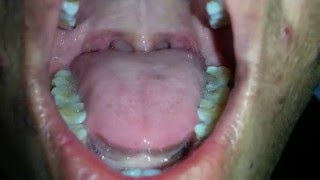 Tongue Fasciculation in MND [upl. by Graaf]