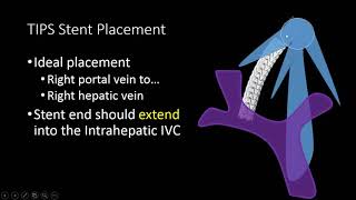 TIPS Stent US Doppler Evaluation [upl. by Elata]