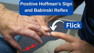 Positive Hoffmans Sign and Babinski Reflex in an MS Patient [upl. by Fosque252]