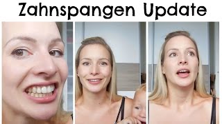 Zahnspangen  Update I Lose Spange I Kosten I AnnaBirdie [upl. by Kerad]