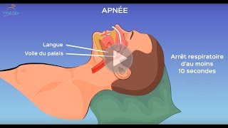 L’apnée du sommeil qu’estce que c’est [upl. by Ailero]