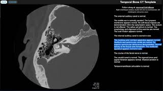 Radiology Walkthroughs  CT Temporal Bone Anatomy [upl. by Juditha]