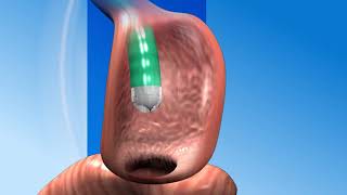 Scarless Revision Surgery after Gastric Bypass [upl. by Boorman]