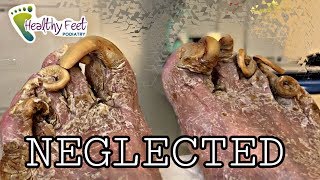 Cutting Neglected Nails EXTREME THICK TOENAILS [upl. by Eiggem]