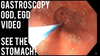 Gastroscopy  OGD  See inside the stomach [upl. by Hendon]