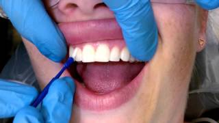 Tips For Applying Fluoride Varnish [upl. by Jeanine811]