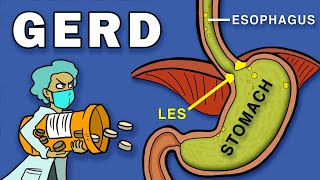 Gastroesophageal Reflux Disease GERD [upl. by Josler]