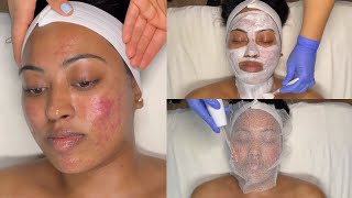 CYSTIC ACNE TREATMENT  WALKIN FACIAL FOR GRADE 3 AND 4 ACNE WITH PRO TIPS  LICENSED ESTHETICIAN [upl. by Stefano]