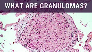 What are Granulomas  Pathology mini tutorial [upl. by Korff273]