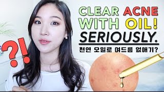 CLEAR ACNE WITH OIL • BEST Oils for Acne Prone Skin [upl. by Iba]