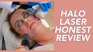 My Halo Laser Experience Honest Review Recovery and Before amp Afters [upl. by Orgel]