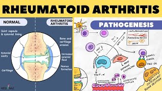 Rheumatoid Arthritis Pathophysiology  Rheumatoid Arthritis Pathogenesis  Arthritis pathophysiology [upl. by Aneele]