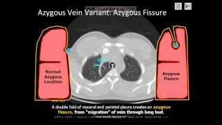 Chest Radiology The Azygous Fissure a normal variant [upl. by Olim968]