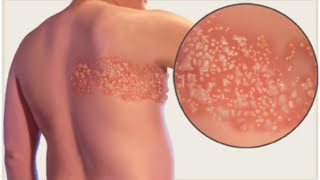 Herpes Zoster Shingles [upl. by Hamimej36]