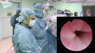 Cystoscopy and placement of guidewire [upl. by Esydnac]