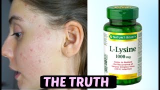 I TOOK LYSINE FOR 2 WEEKS STRAIGHT THIS IS WHAT HAPPENED TO ACNE SCARS [upl. by Acino379]