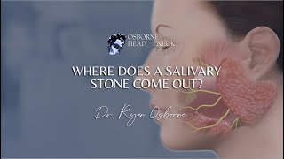 Where does a salivary stone come out [upl. by Cowles]