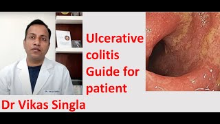 Ulcerative colitis Treatment and Symptoms अल्सरेटिव कोलाइटिस In Hindi Dr Vikas Singla [upl. by Oswal]