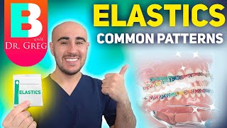 BRACES ELASTICS Most Common Patterns for Braces [upl. by Strauss360]