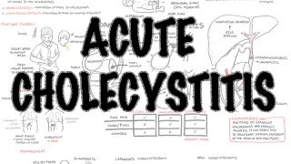 Acute Cholecystitis  Overview signs and symptoms pathophysiology treatment [upl. by Nwahs345]