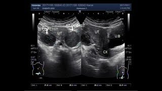 3 Causes of Polycystic Ovarian Syndrome PCOS amp High Androgens – Dr Berg [upl. by Neumeyer]