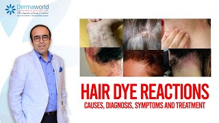 Hair dye reactions  Causes Diagnosis Symptoms and Treatment [upl. by Nerti]