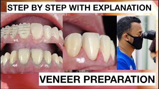 Step by Step Minimally Invasive Veneers Preparation  General Dentist Griya RR [upl. by Annor]