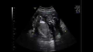 La face du foetus lors de léchographie morphologique ☺️ [upl. by Tully]