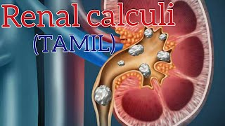 Renal calculi in tamil Classmedics [upl. by Diella]