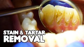 Dental Cleaning EXPLAINED  Stain amp Tartar Removal [upl. by Ramin]