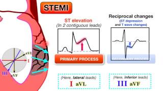 Ischemia 67  STEMI on ECG [upl. by Clovah]