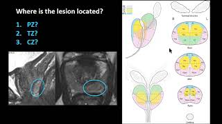 ISMRM MR Academy  Prostate MRI Image Interpretation [upl. by Kraus]