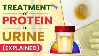 Treatment Of Protein In Urine Explained [upl. by Ronyar]