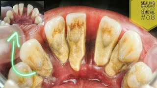 Scaling Karang Gigi Tebal Tartar Removal 08 Dokter Gigi Ruliyanto 歯石の厚さのスケーリング歯石の除去 [upl. by Ordnazil]