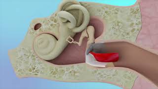 Eardrum Hole Repair Animation [upl. by Velma463]