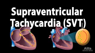 Supraventricular Tachycardia SVT PSVT Animation [upl. by Deenya]