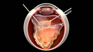 Retinal Detachment  Signs Symptoms and Treatment [upl. by Dever]