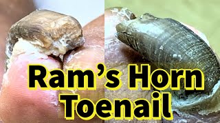 Rams Horn Toenail Severe Fungal Toenail [upl. by Terrence]